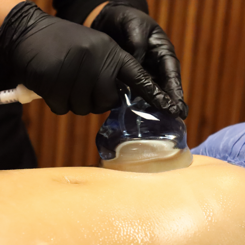 Abdomen Drenaje De La Liposuccion Liposucción Drenaje Linfatico